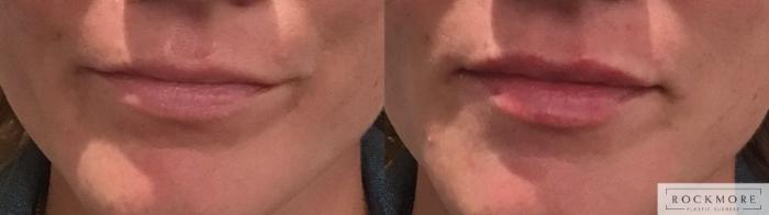 Before & After Lip Augmentation Case 334 Front View in Albany & Latham, New York