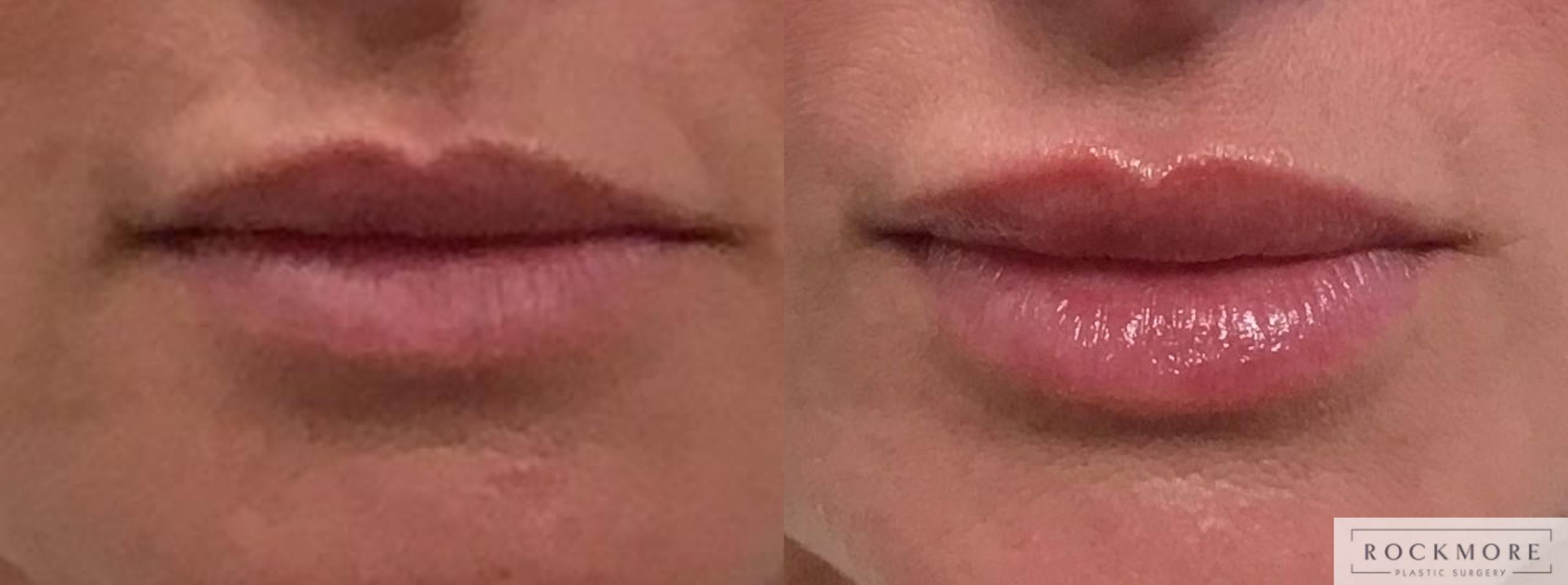 Before & After Lip Augmentation Case 341 Front View in Albany & Latham, New York