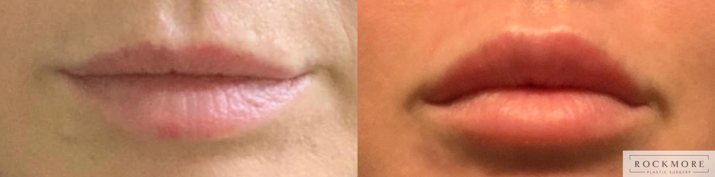Before & After Lip Augmentation Case 402 Front View in Albany & Latham, New York