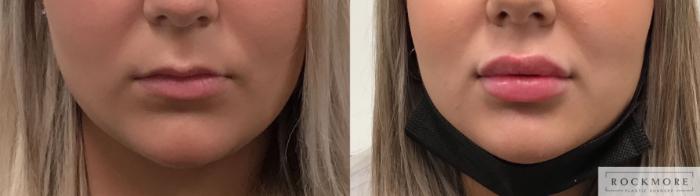 Before & After Lip Augmentation Case 413 Front View in Albany & Latham, New York