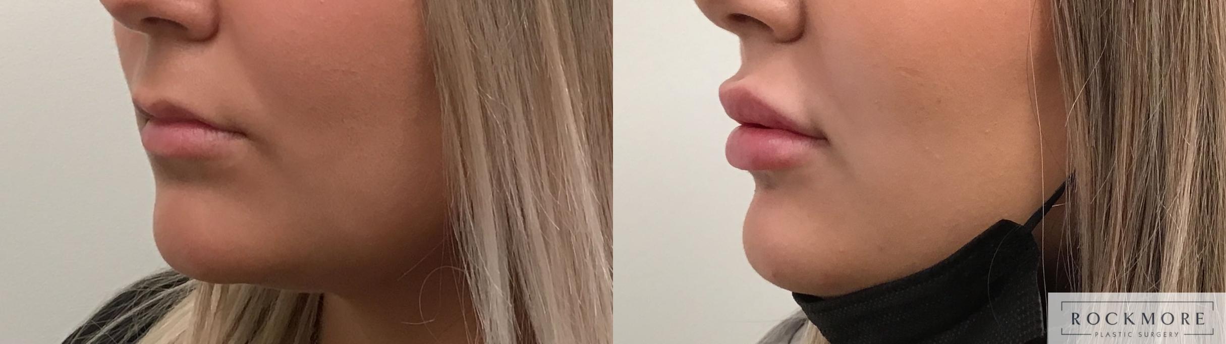 Before & After Lip Augmentation Case 413 Left Side View in Albany & Latham, New York