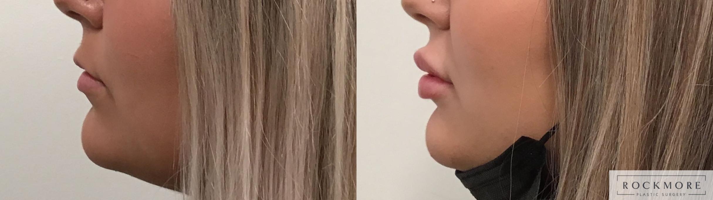 Before & After Lip Augmentation Case 413 Right Side View in Albany & Latham, New York