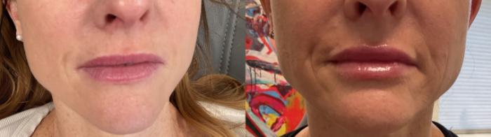 Before & After Lip Augmentation Case 477 Front View in Albany, Latham & Saratoga, New York