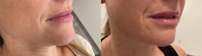 Before & After Lip Augmentation Case 477 Right Oblique View in Albany, Latham & Saratoga, New York