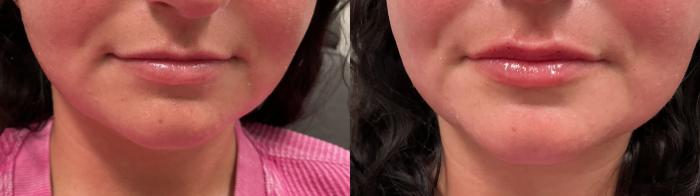 Before & After Lip Augmentation Case 479 Front View in Albany, Latham & Saratoga, New York