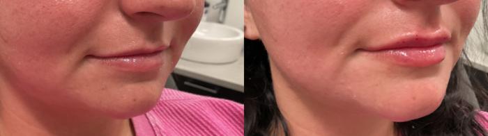 Before & After Lip Augmentation Case 479 Right Oblique View in Albany, Latham & Saratoga, New York