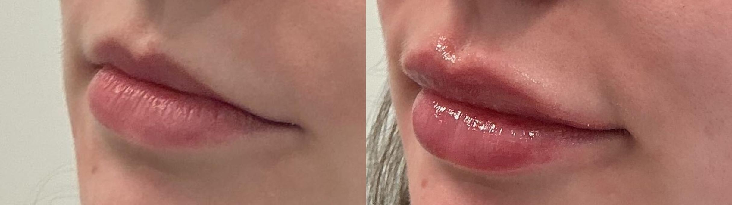 Before & After Lip Augmentation Case 505 Left Oblique View in Albany, Latham & Saratoga, New York