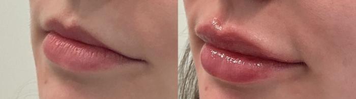 Before & After Lip Augmentation Case 505 Left Oblique View in Albany, Latham & Saratoga, New York