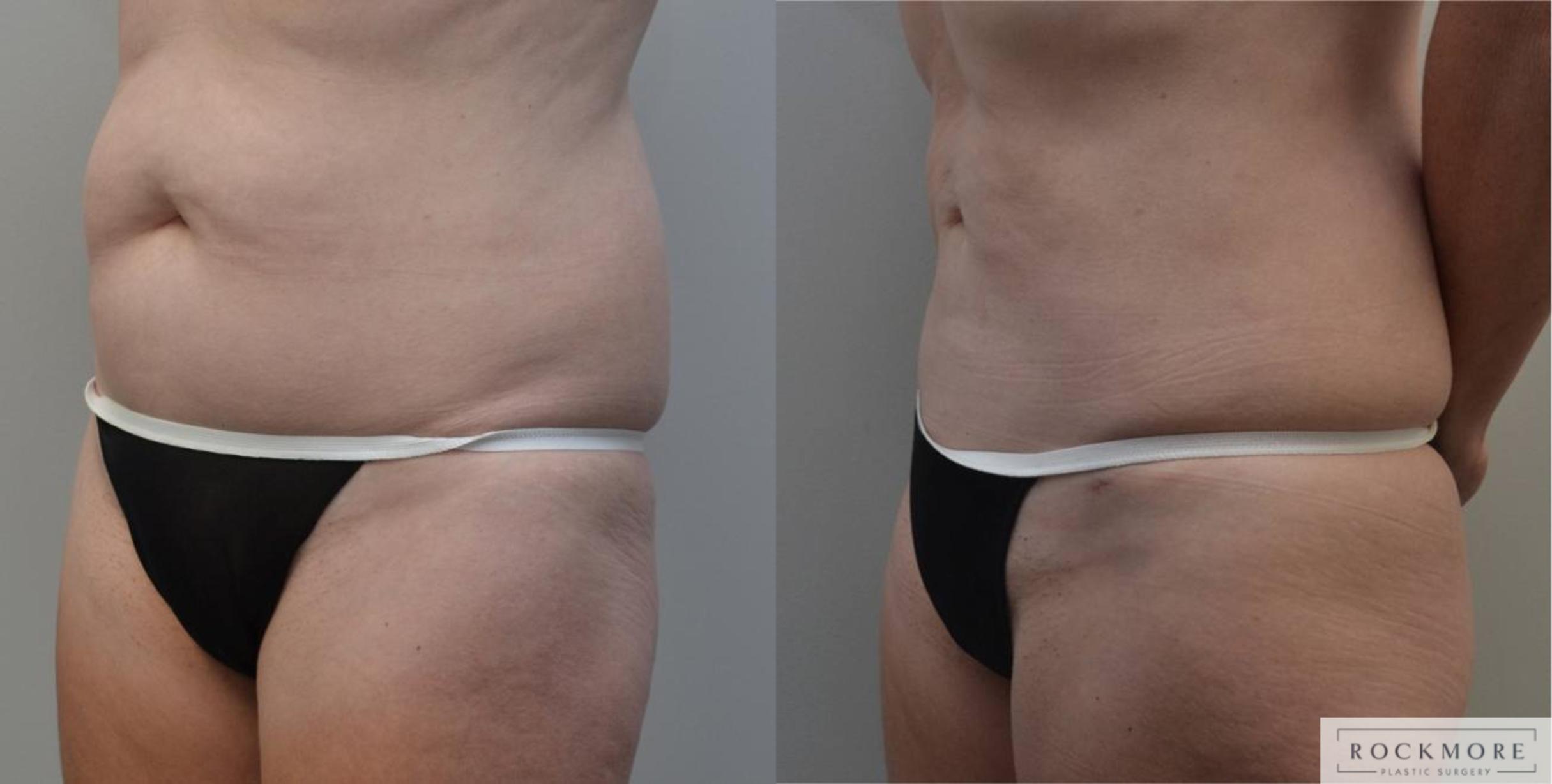Before & After Liposuction Case 194 View #1 View in Albany & Latham, New York