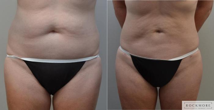 Before & After Liposuction Case 194 View #2 View in Albany & Latham, New York