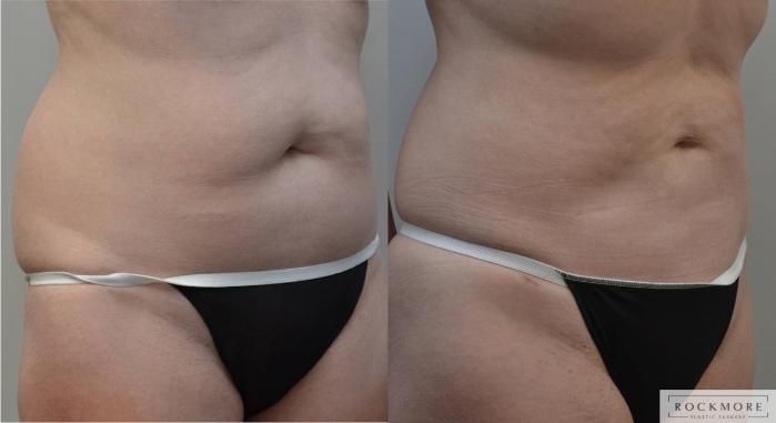 Before & After Liposuction Case 194 View #3 View in Albany & Latham, New York