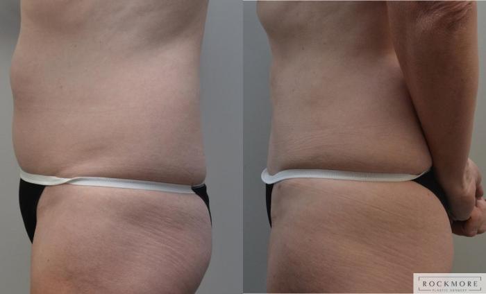 Before & After Liposuction Case 194 View #4 View in Albany & Latham, New York