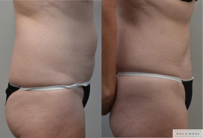 Before & After Liposuction Case 194 View #5 View in Albany & Latham, New York