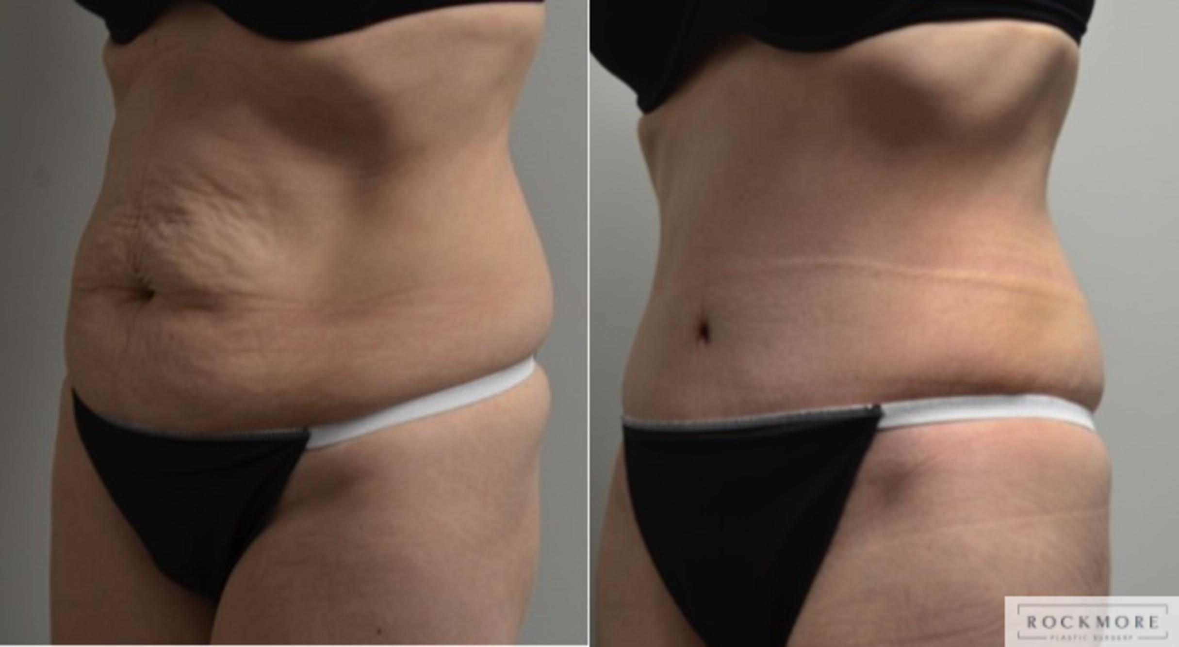 Before & After Tummy Tuck Case 215 View #1 View in Albany & Latham, New York