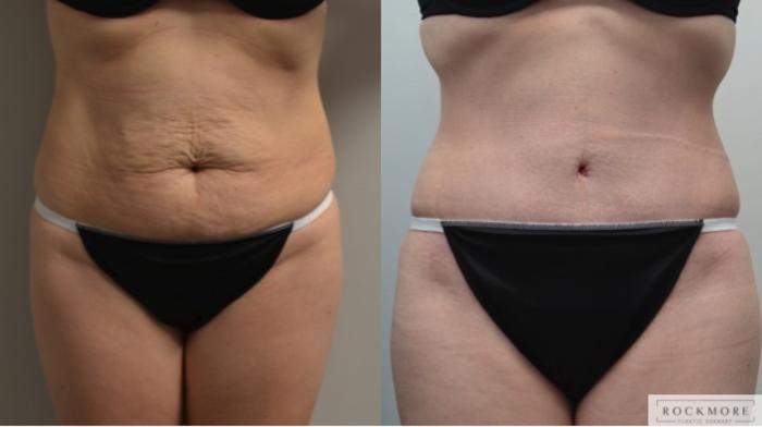 Before & After Liposuction Case 215 View #3 View in Albany & Latham, New York