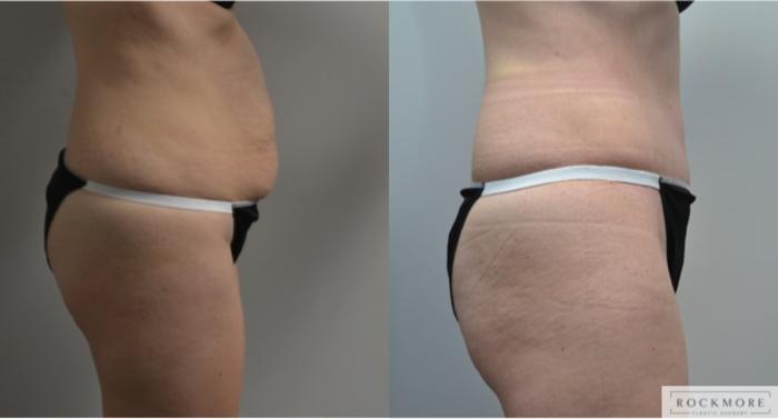 Before & After Liposuction Case 215 View #4 View in Albany & Latham, New York
