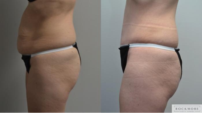 Before & After Liposuction Case 215 View #5 View in Albany & Latham, New York