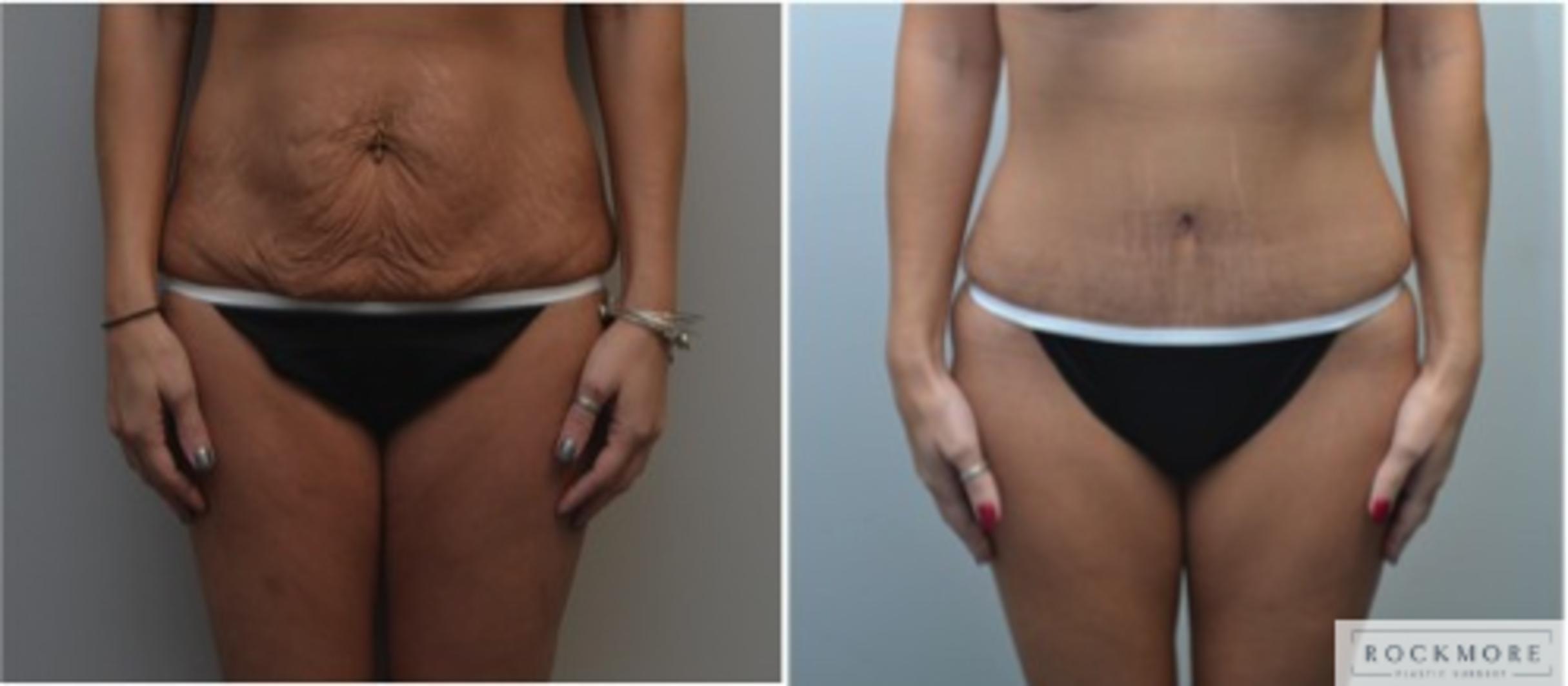Before & After Liposuction Case 217 View #1 View in Albany & Latham, New York