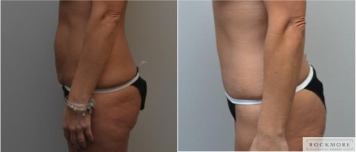 Before & After Liposuction Case 217 View #2 View in Albany & Latham, New York