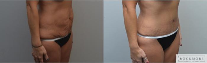 Before & After Liposuction Case 217 View #3 View in Albany & Latham, New York