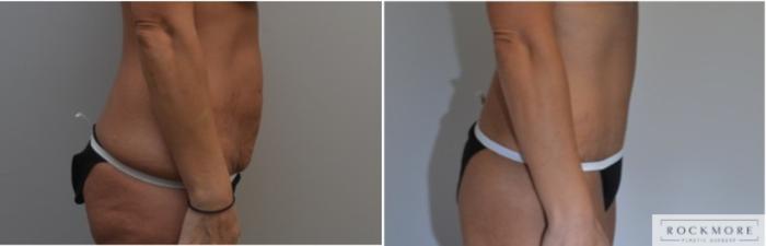 Before & After Liposuction Case 217 View #4 View in Albany & Latham, New York