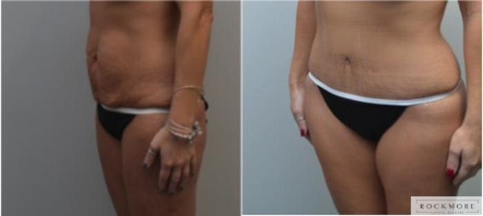 Before & After Liposuction Case 217 View #5 View in Albany & Latham, New York