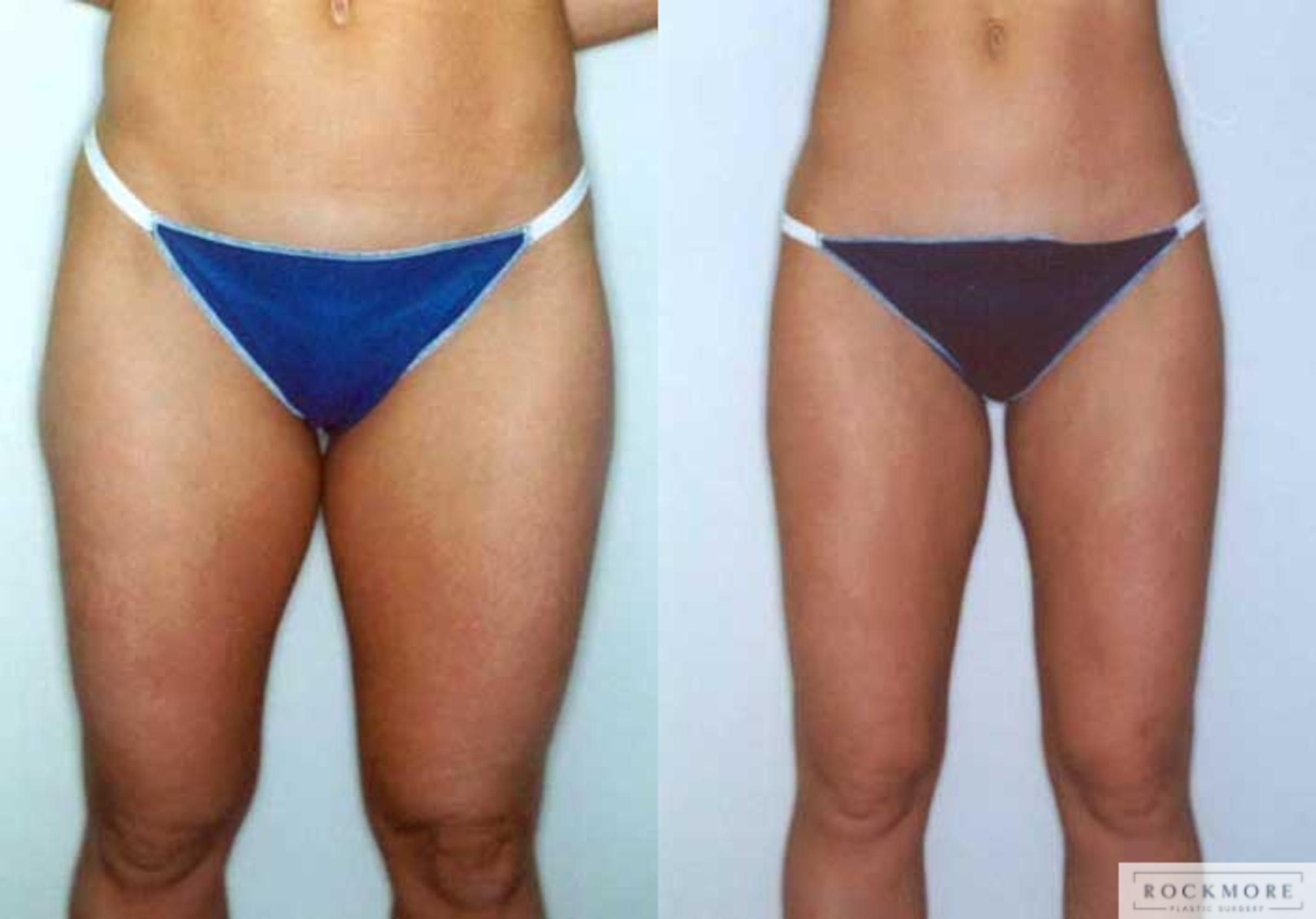 Before & After Liposuction Case 22 View #1 View in Albany & Latham, New York