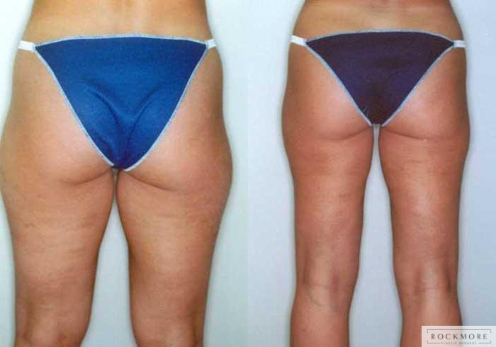 Before & After Liposuction Case 22 View #2 View in Albany & Latham, New York