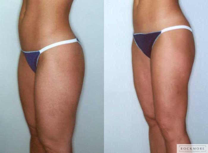 Before & After Liposuction Case 22 View #3 View in Albany & Latham, New York