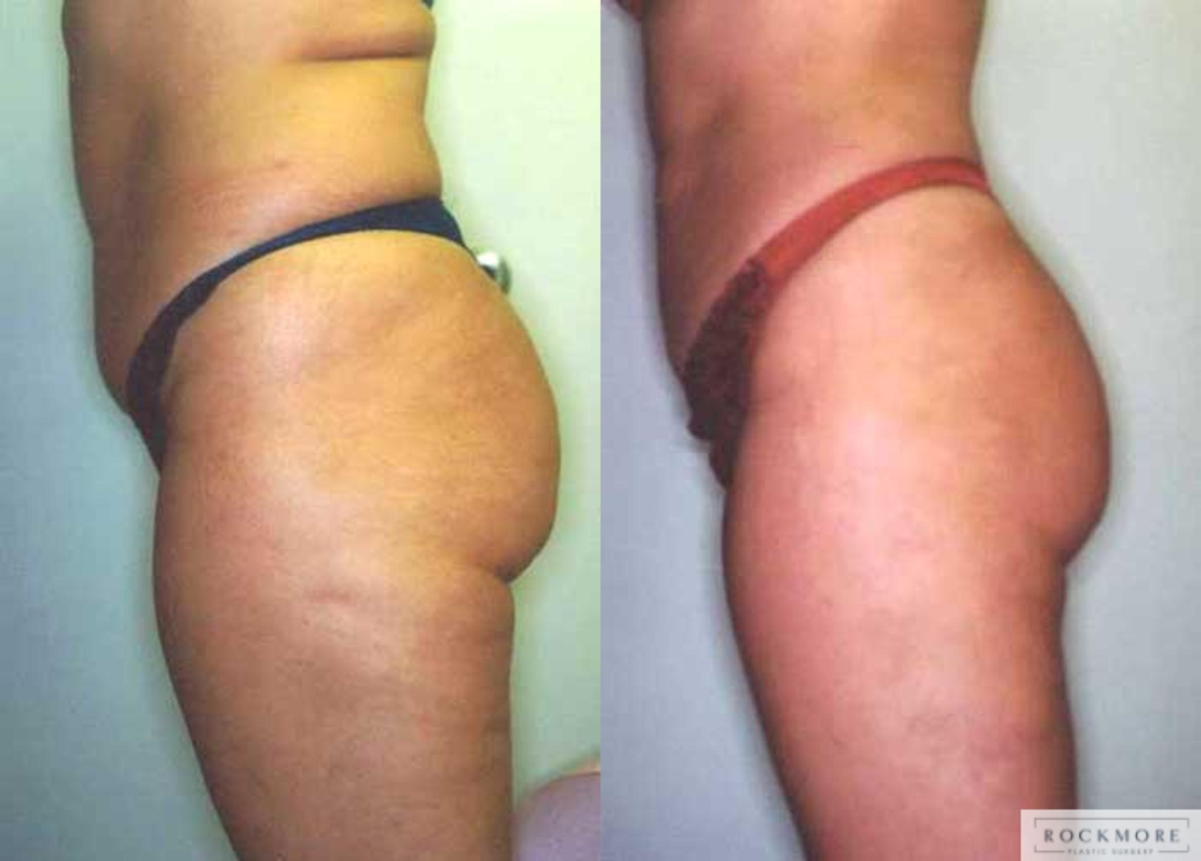 Before & After Liposuction Case 23 View #1 View in Albany & Latham, New York