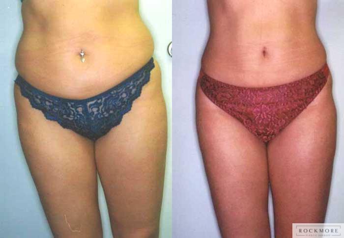 Before & After Liposuction Case 23 View #2 View in Albany & Latham, New York