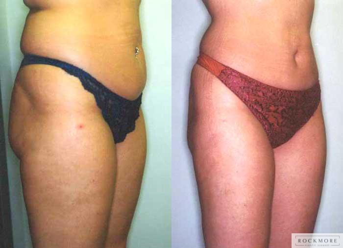 Before & After Liposuction Case 23 View #3 View in Albany & Latham, New York