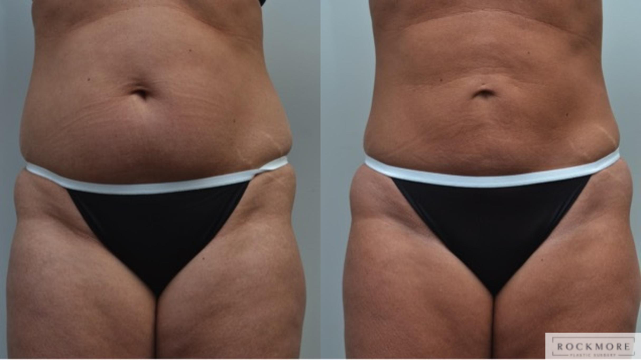 Before & After Liposuction Case 238 View #1 View in Albany & Latham, New York