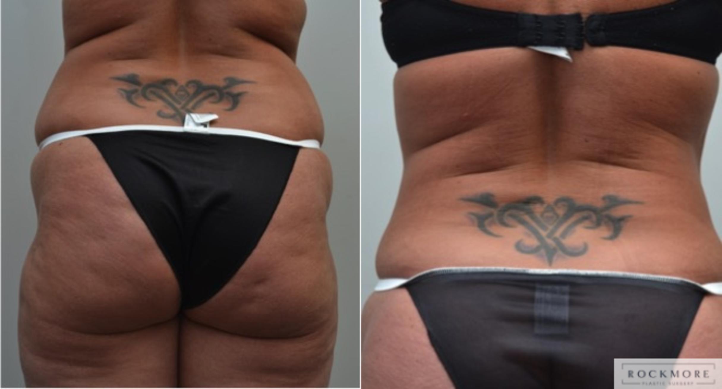Before & After Liposuction Case 238 View #2 View in Albany & Latham, New York