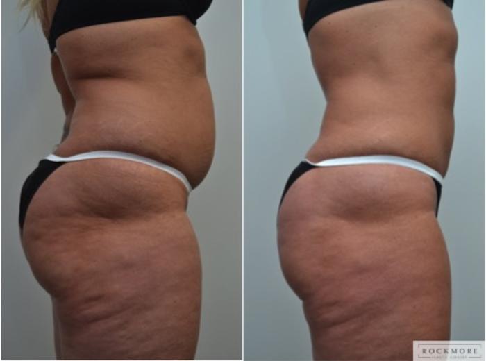 Before & After Liposuction Case 238 View #3 View in Albany & Latham, New York