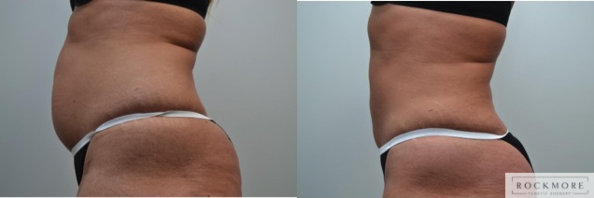 Before & After Liposuction Case 238 View #4 View in Albany & Latham, New York