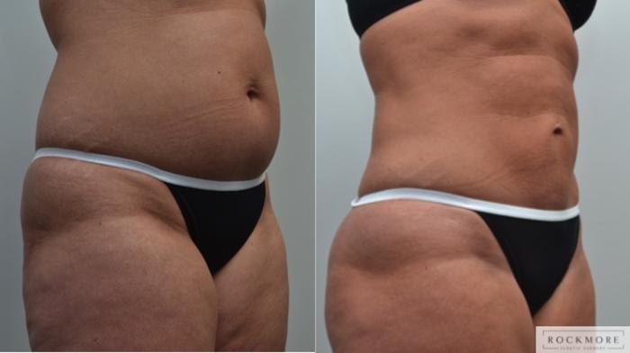 Before & After Liposuction Case 238 View #5 View in Albany & Latham, New York