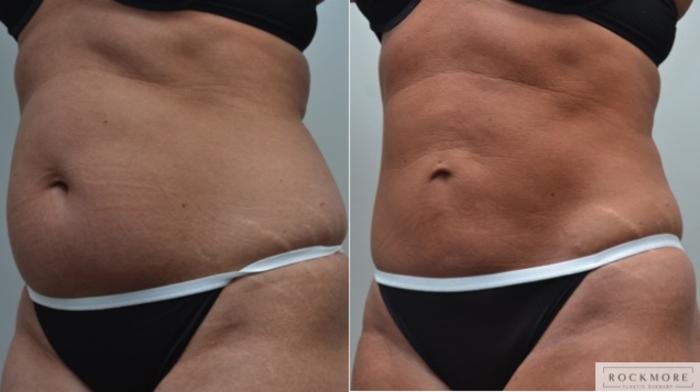 Before & After Liposuction Case 238 View #6 View in Albany & Latham, New York