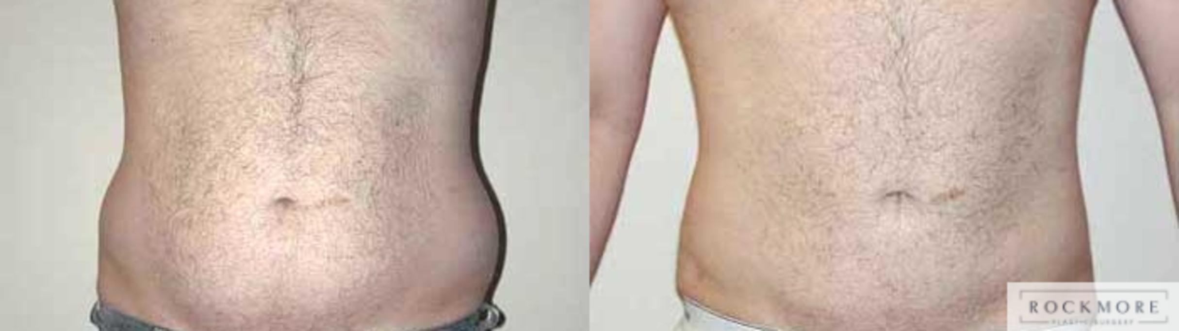 Before & After Liposuction Case 24 View #1 View in Albany & Latham, New York