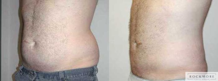 Before & After Liposuction Case 24 View #2 View in Albany & Latham, New York