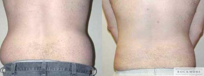 Before & After Liposuction Case 24 View #3 View in Albany & Latham, New York