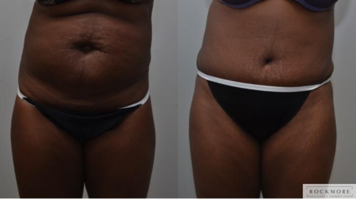 Before & After Liposuction Case 275 View #1 View in Albany & Latham, New York