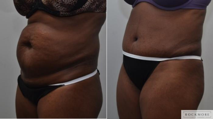 Before & After Liposuction Case 275 View #2 View in Albany & Latham, New York