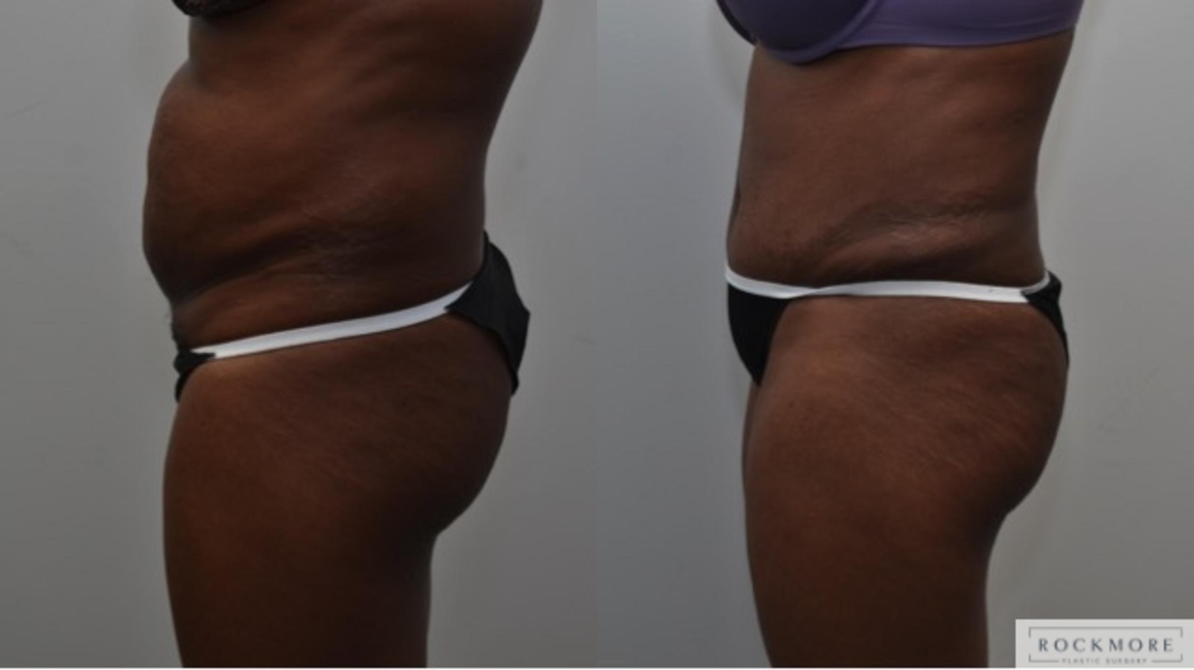 Before & After Liposuction Case 275 View #3 View in Albany & Latham, New York