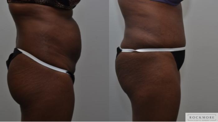 Before & After Liposuction Case 275 View #4 View in Albany & Latham, New York