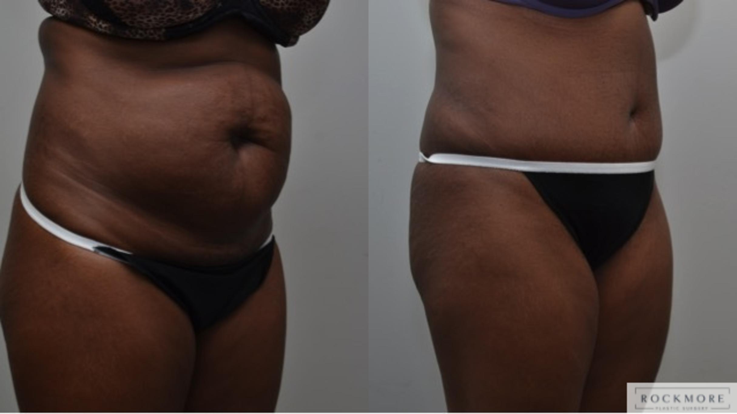 Before & After Liposuction Case 275 View #5 View in Albany & Latham, New York