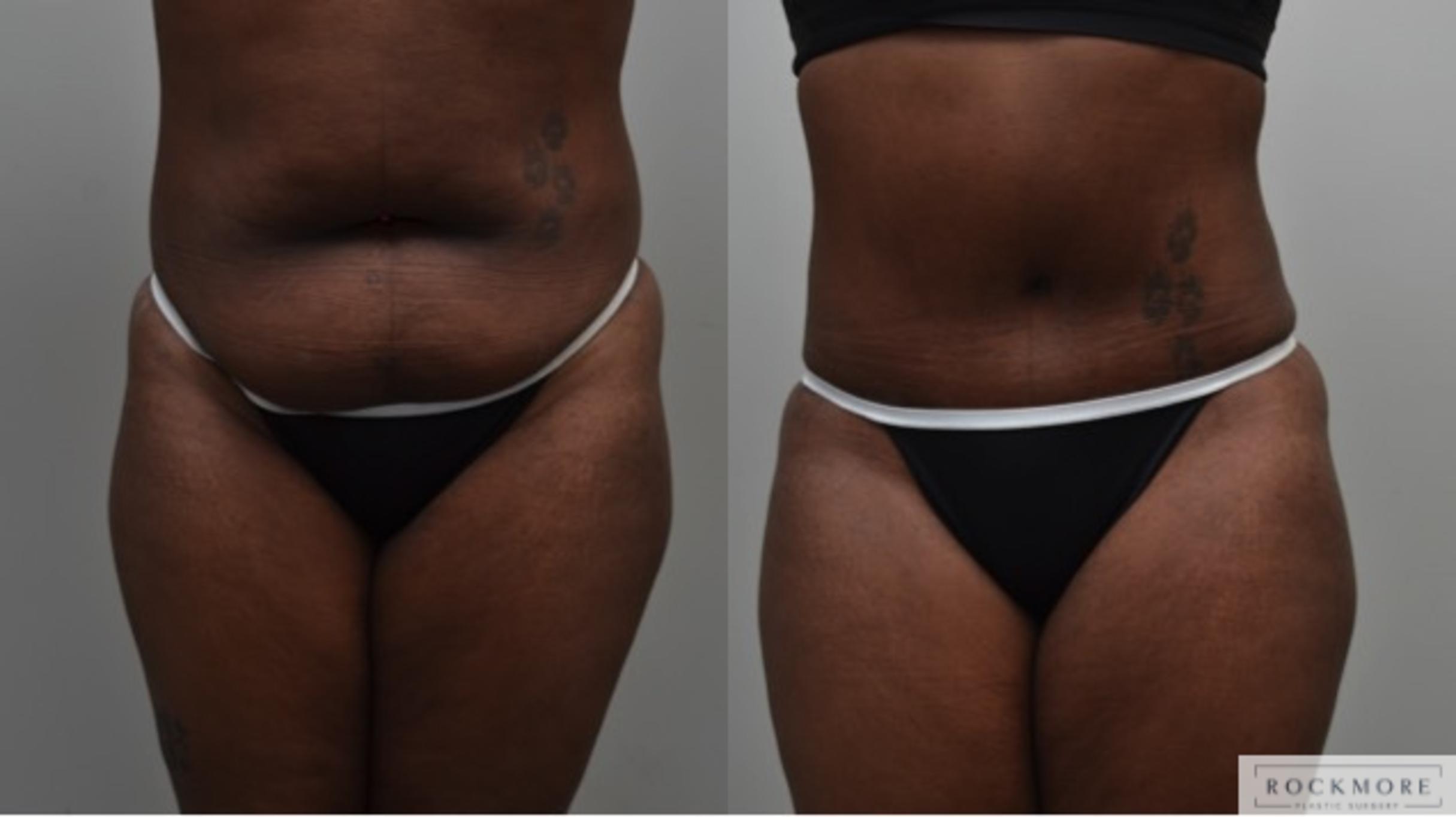 Before & After Liposuction Case 281 View #1 View in Albany & Latham, New York