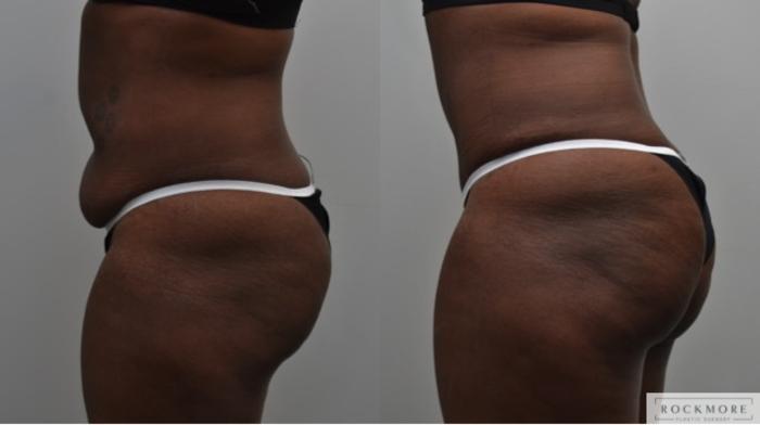 Before & After Liposuction Case 281 View #2 View in Albany & Latham, New York