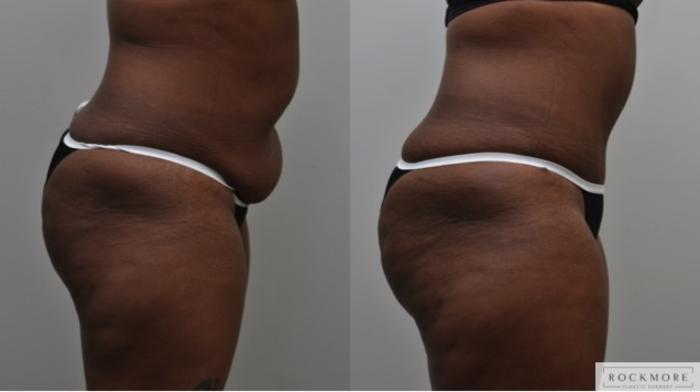 Before & After Liposuction Case 281 View #3 View in Albany & Latham, New York
