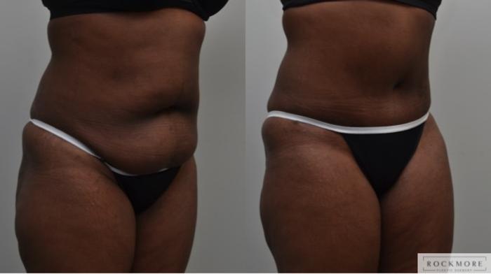 Before & After Liposuction Case 281 View #4 View in Albany & Latham, New York